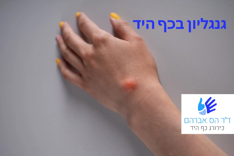 גנגליון בכף היד