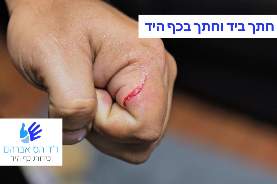 חתך בכף היד